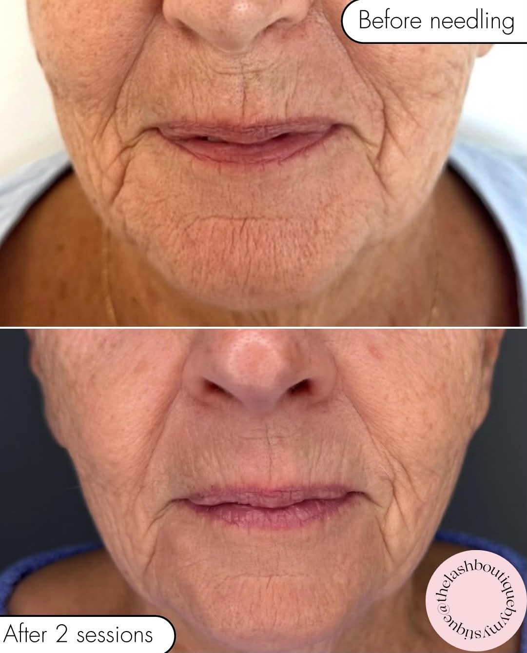 Skin treatment result