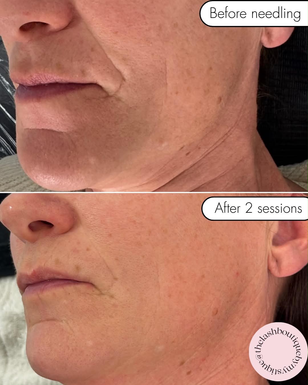 Skin needling before and after